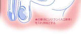 インポテンツ　ED　外科手術[外科手術]
